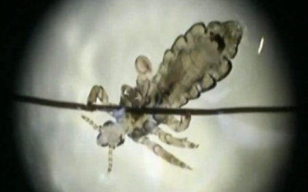 Les pires choses à faire quand on a des poux!