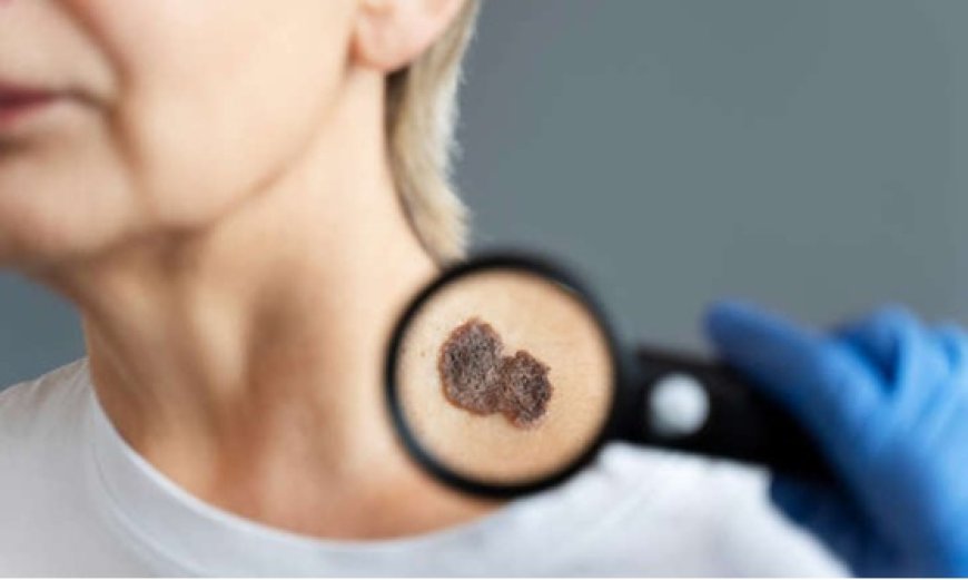 Cancer de la peau chez 50 ans et plus : il n’y a pas que les grains de beauté à surveiller.