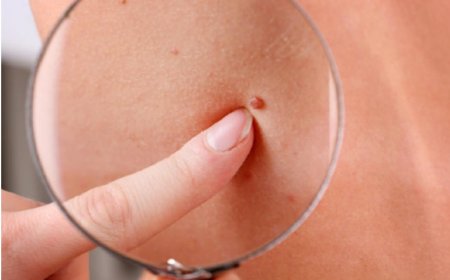 La technique des médecins pour repérer un grain de beauté qui cache un cancer.