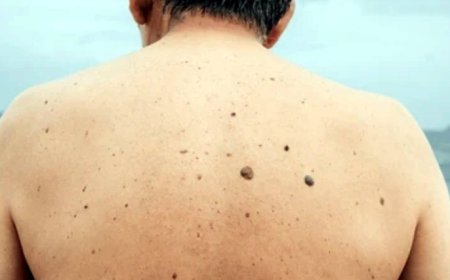 Comment supprimer des verrues sur le sorps sans les brûler?