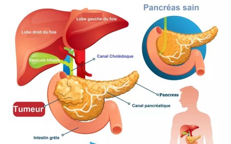Cancer pancréas + le foie