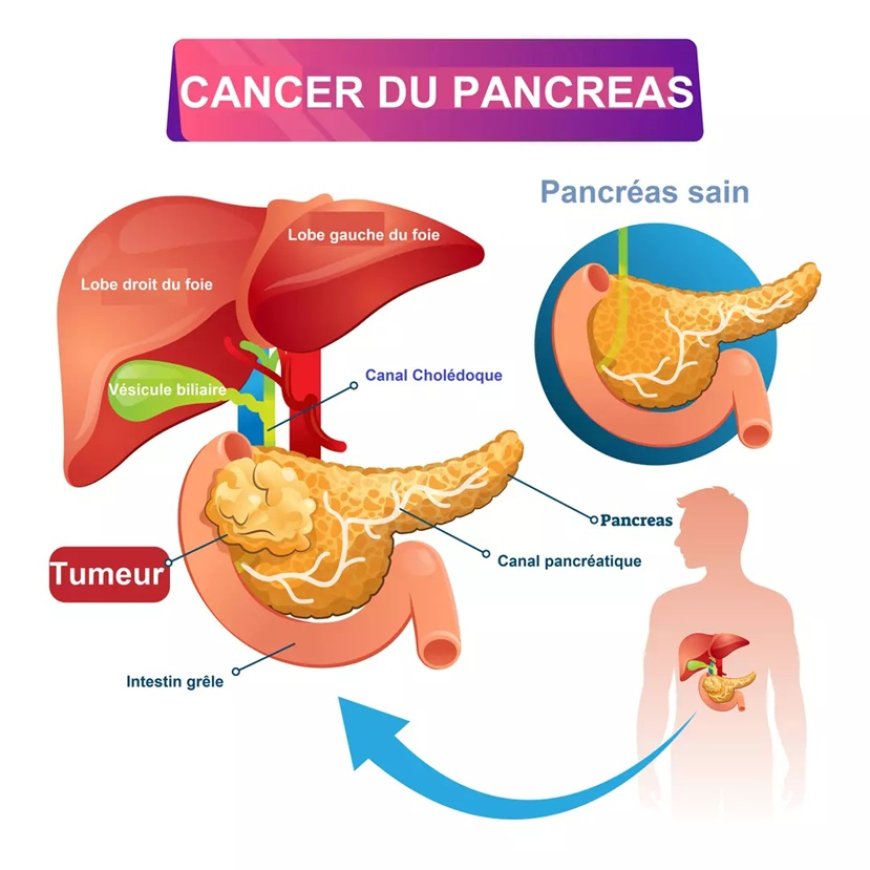 Cancer pancréas + le foie