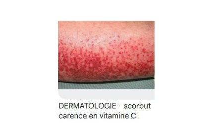 Le scorbut est de retour!