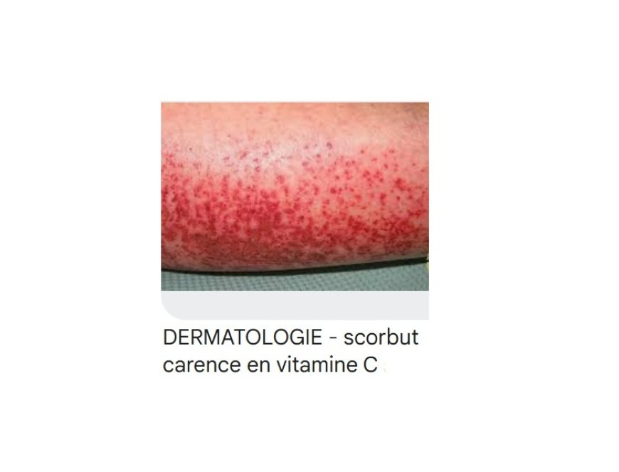 Le scorbut est de retour!