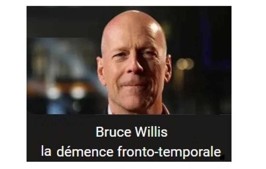 Qu’est‑ce que la démence fronto-temporale (DFT) ?